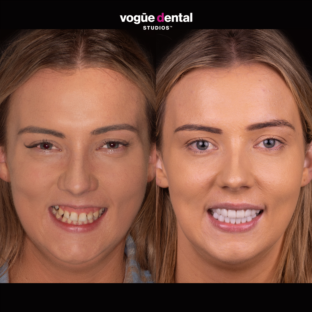 Before and after porcelain veneers at Vogue Dental Studios - Face View Rebekah 