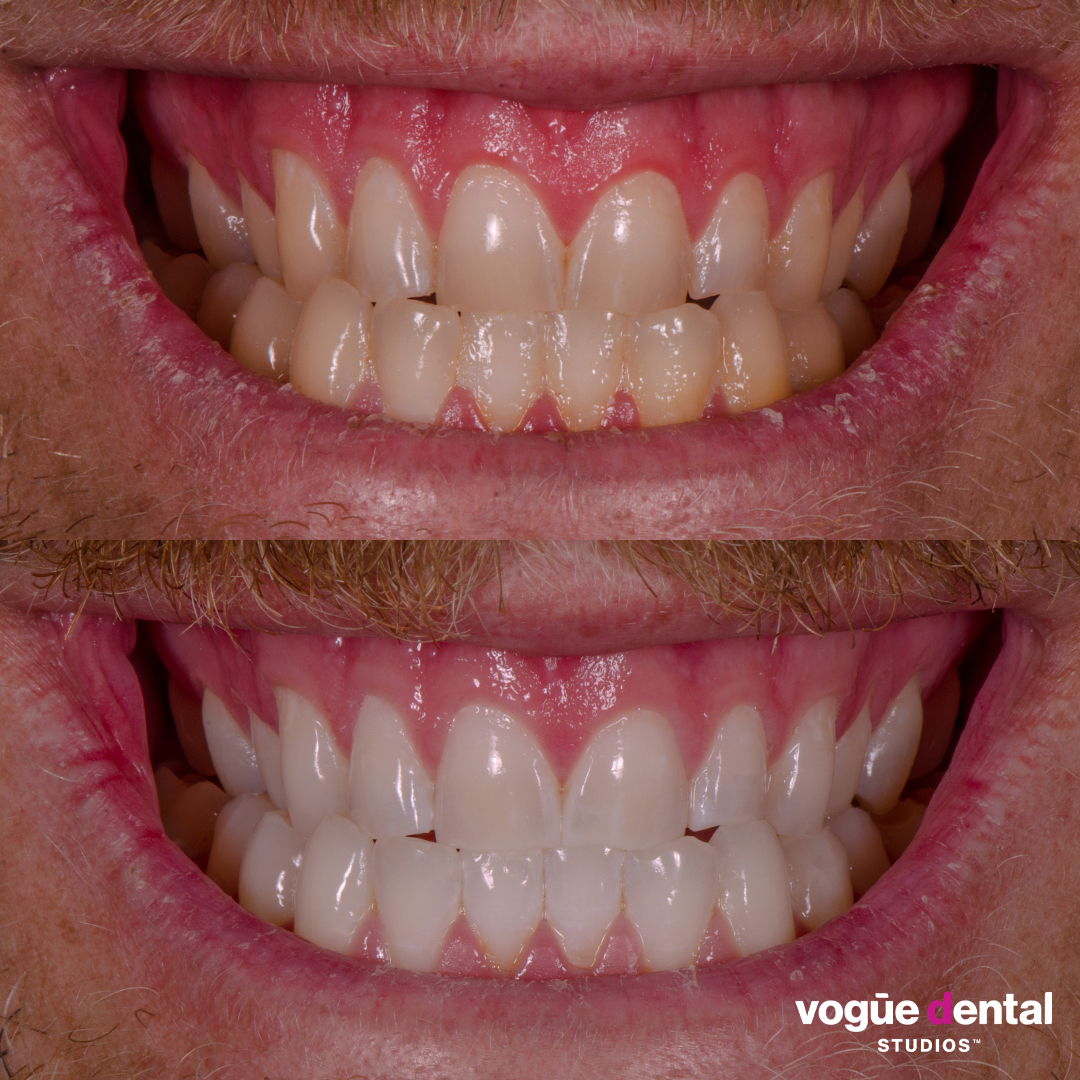 Before and after Zoom in-chair teeth whitening at Vogue Dental Studios - front teeth view Luke.