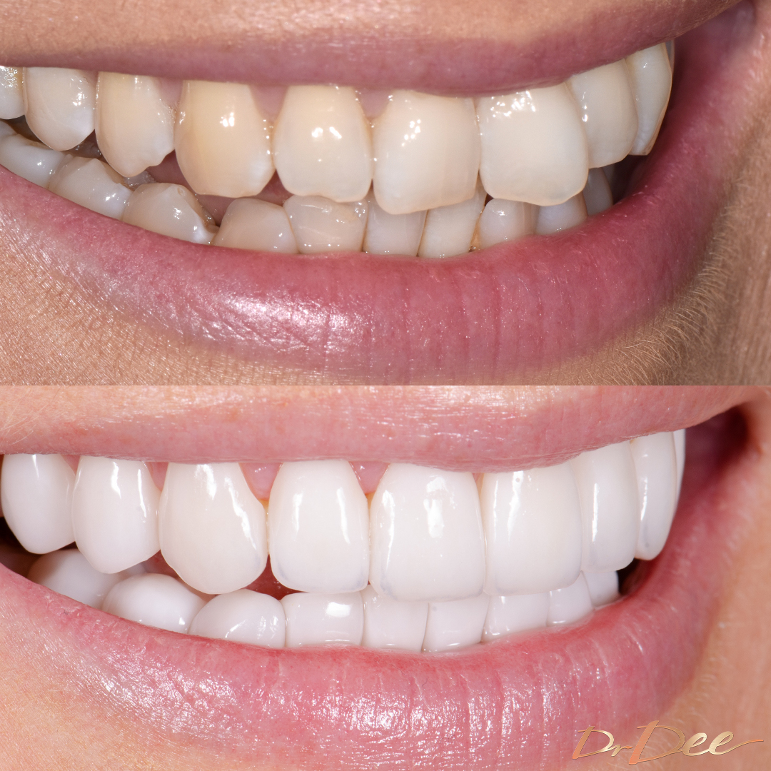 Joanne Todd's smile transformation after Picasso Porcelain Veneers.