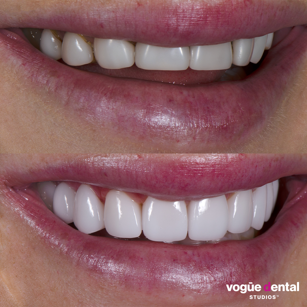 Before and after porcelain veneers smile makeover at Vogue Dental Studios - right teeth view Ines.