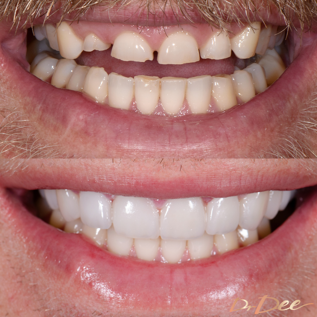 Jake Edwards smile makeover front teeth view.