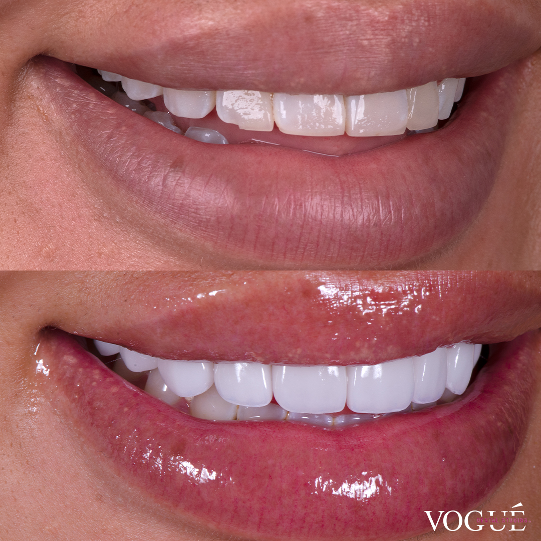 Miss Zedd revision veneers at Vogue Dental Studios before and after right view.