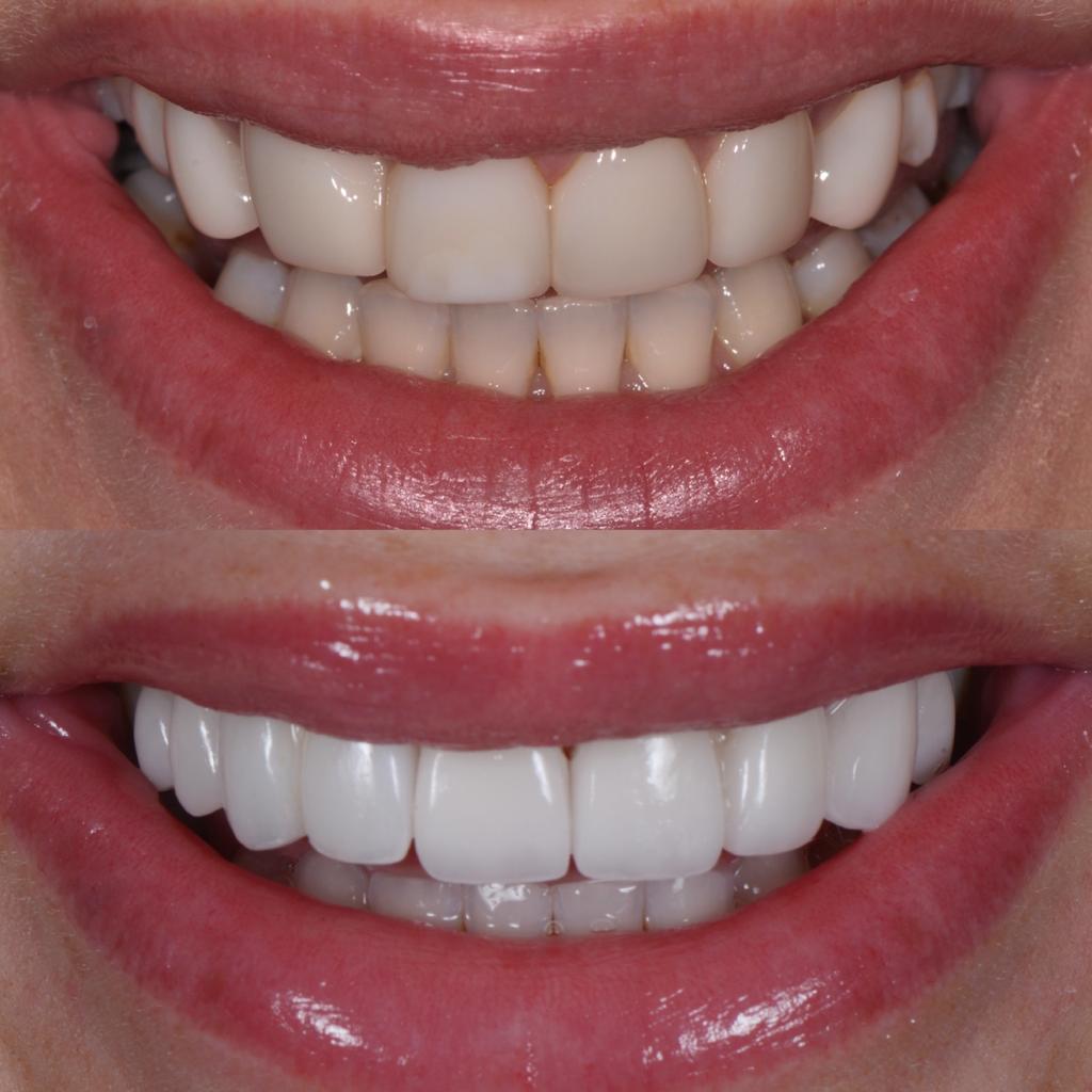 Jessika Power before and after porcelain veneer smile transformation - front teeth view.