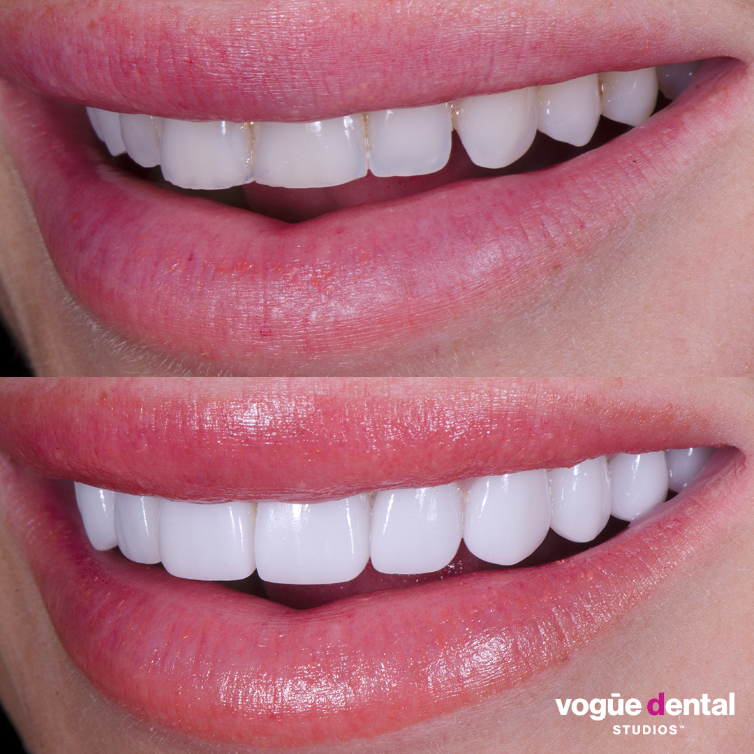 Before and after porcelain veneers smile makeover at Vogue Dental Studios - right teeth view Tash Herz.