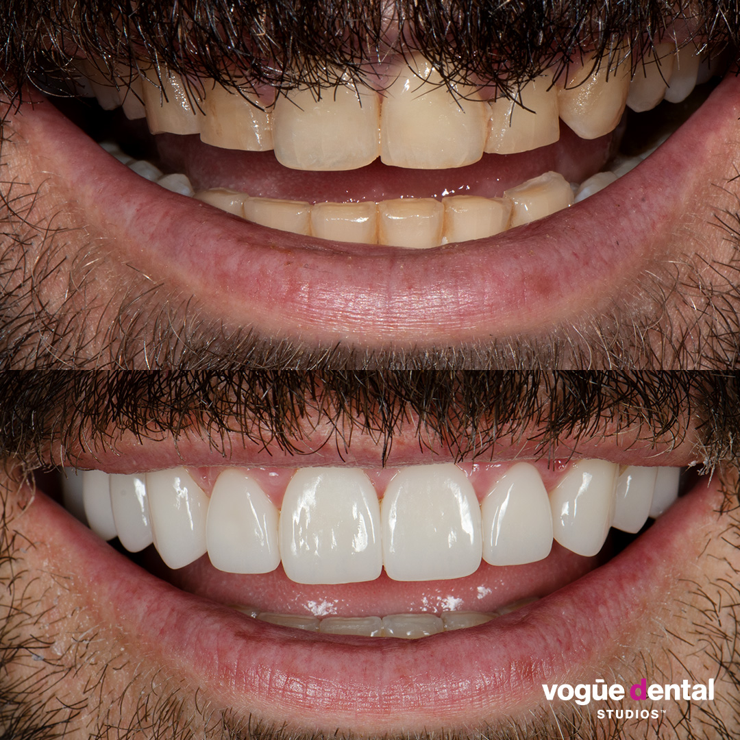 Before and after porcelain veneers Anthony rounded shapes - front smile view