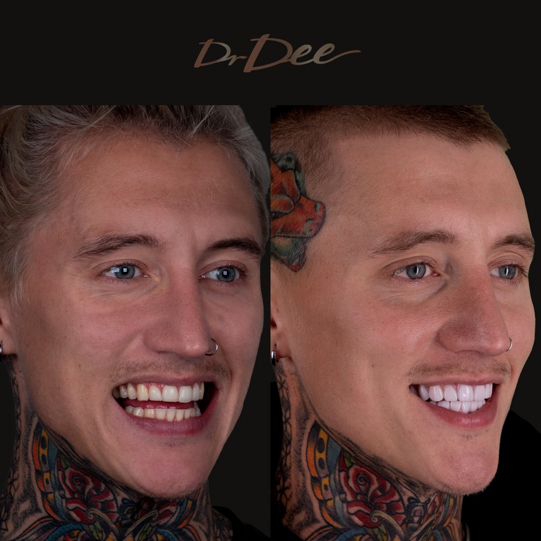 Ciarran Stott side by side comparison before and after smile makeover. 