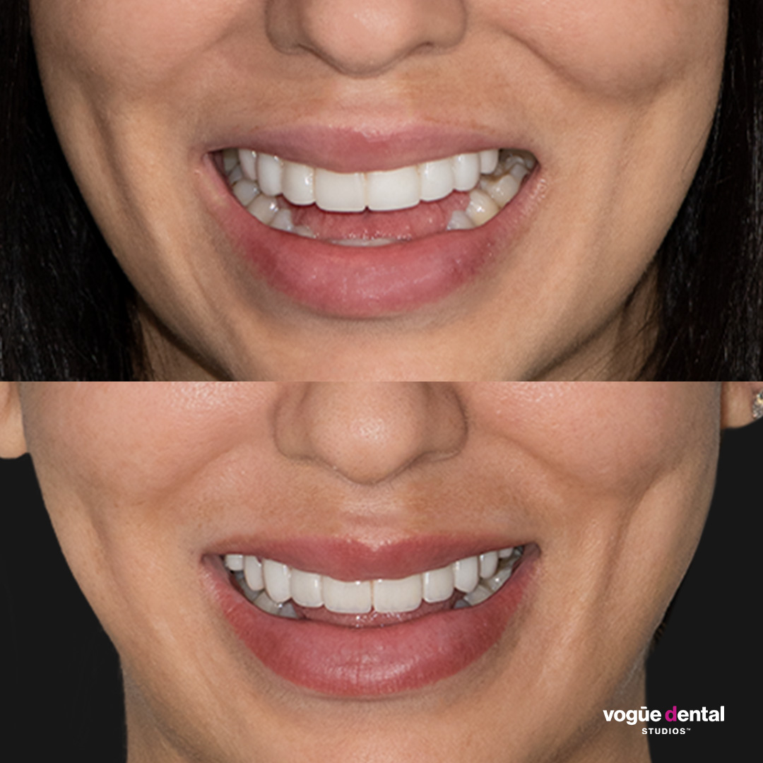 Carolina Santos revision veneers custom smile design Vogue Dental Studios - half face front