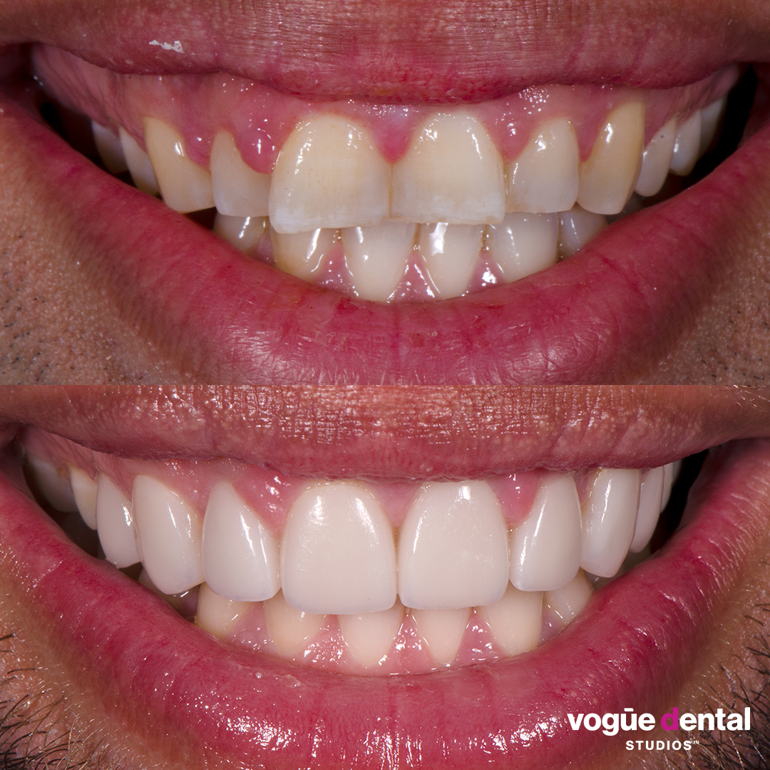 Before and after butterfly teeth with porcelain veneers at Vogue Dental Studios - front teeth view Chris.
