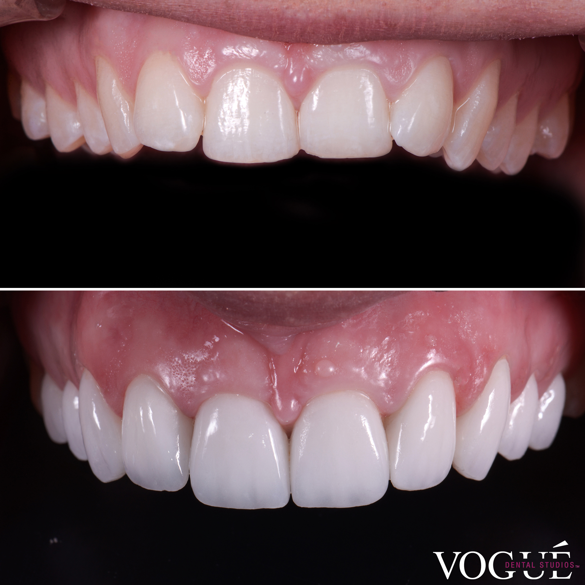 Simone Anderson porcelain veneers smile makeover by Dr Dee.
