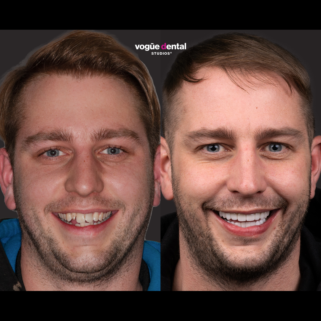 Before and after uneven teeth with porcelain veneers at Vogue Dental Studios - front face view Josh.
