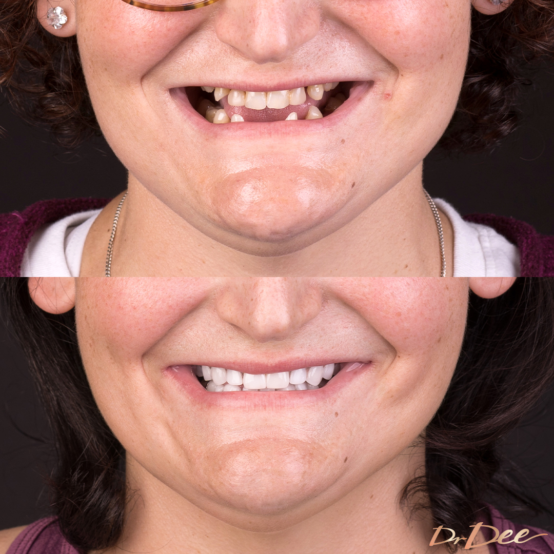 Bring Back a Smile Foundation patient Jacqui before and after veneers gaps