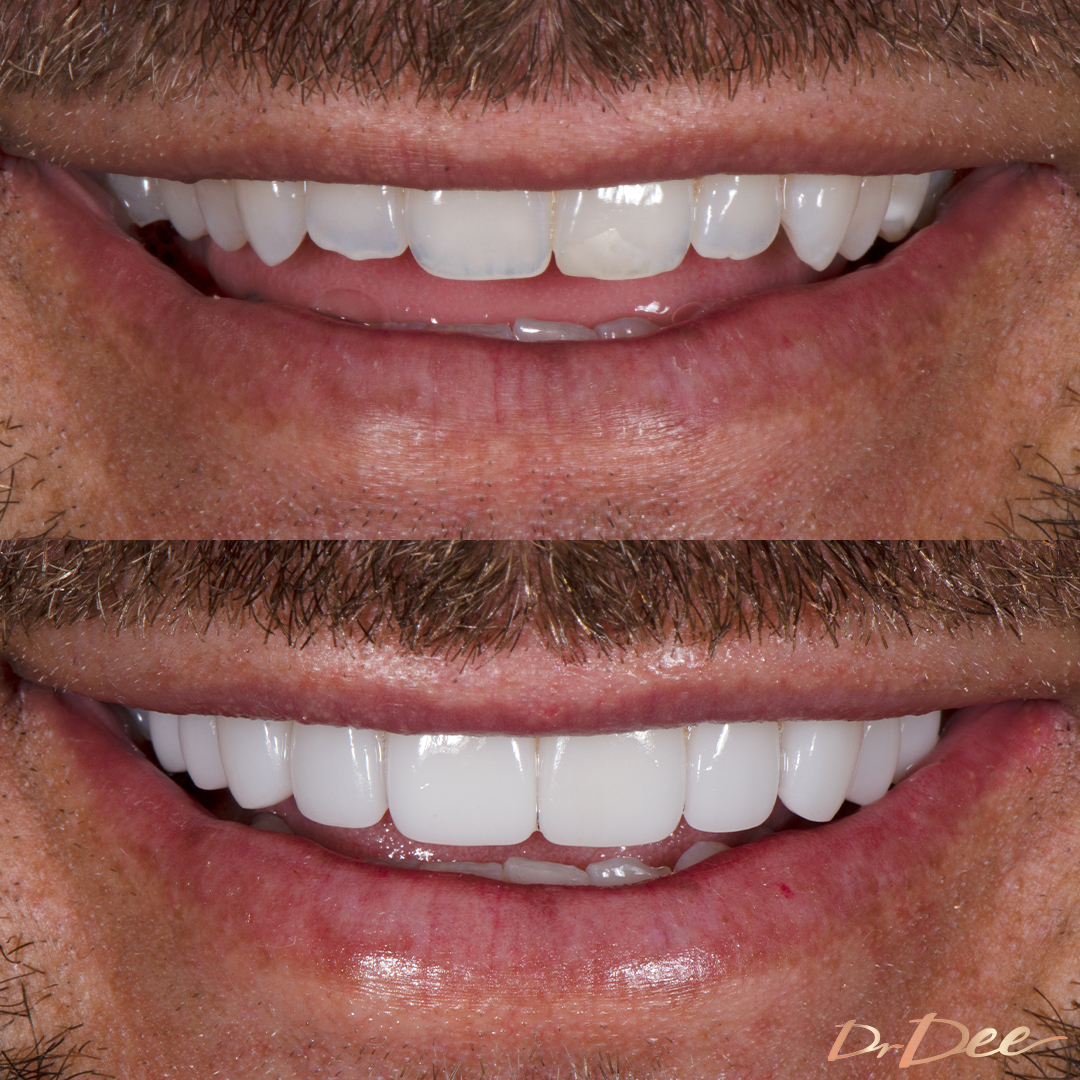 Carlin Sterritt before and after porcelain veneers small teeth, front view.