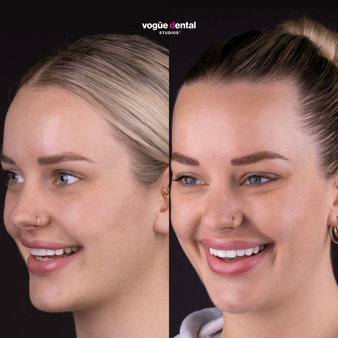 Picasso Porcelain Veneers Before And After Heidi Vogue Dental Studios