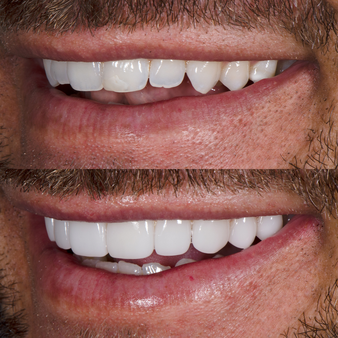 Carlin Sterritt before and after porcelain veneers small teeth, left view.