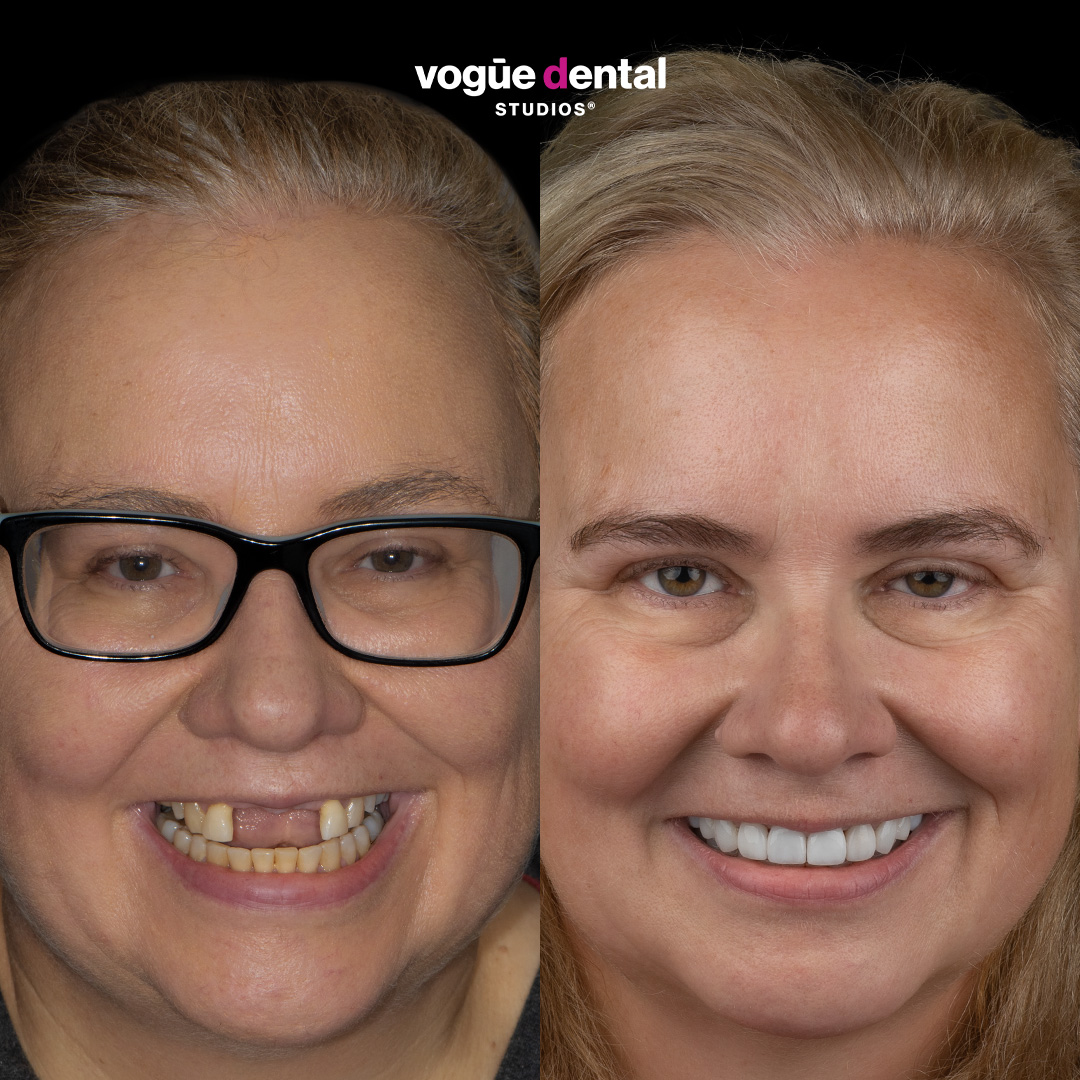 Before and after porcelain veneers and implant smile makeover at Vogue Dental Studios - front view Mandy