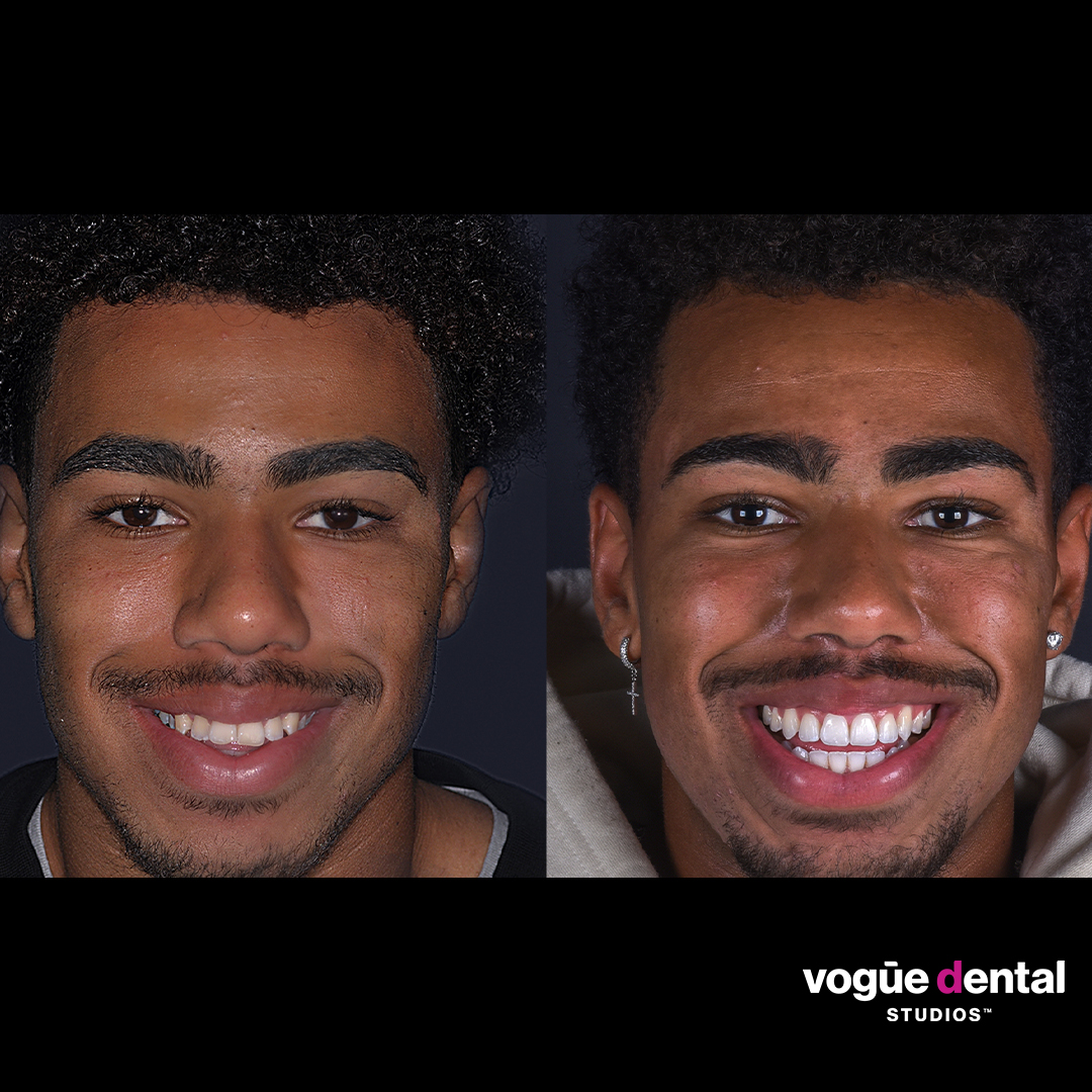 Isaac Invisalign and whitening at Vogue Dental Studios - Face smiling view 