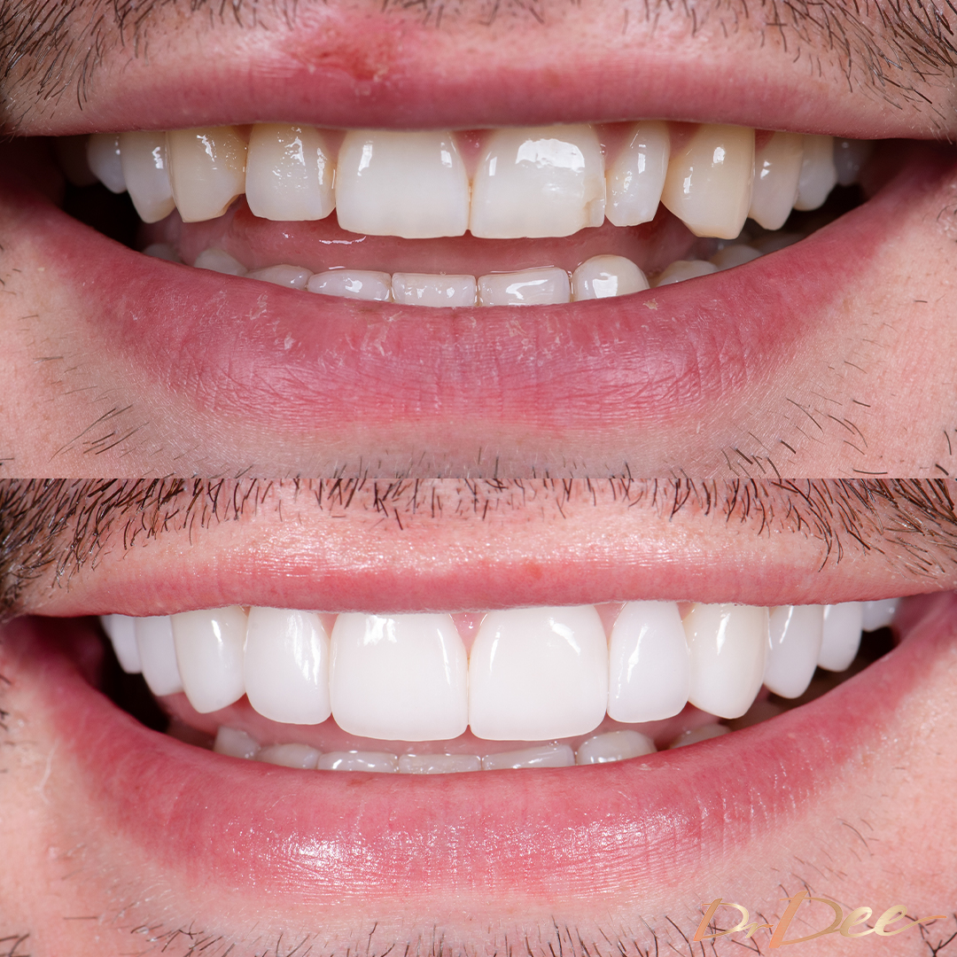 Brandon Smile before and after canted smile with porcelain veneers.