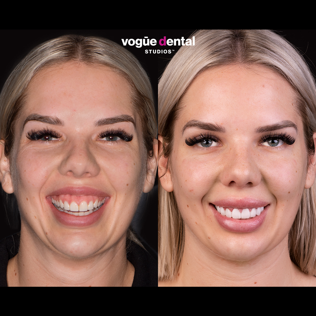 Before and after gum laser surgery in combination with porcelain veneers at Vogue Dental Studios - front face view Kate