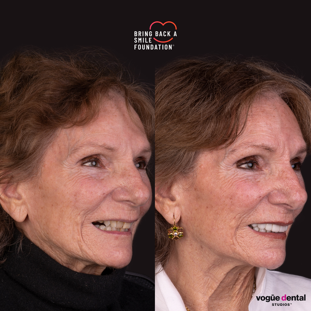 Anna, a cancer patient, before and after her smile makeover with porcelain veneers - right view