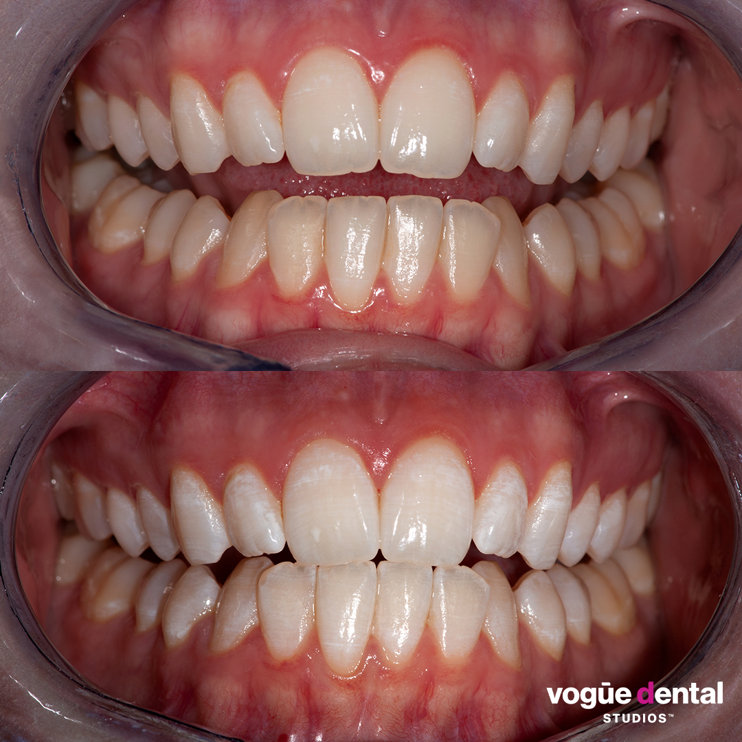 Before and after in-chair teeth whitening at Vogue Dental Studios - front retracted view Jessica.