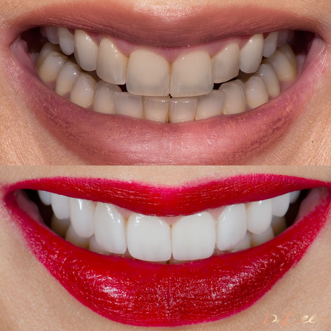 Before and after porcelain veneers Rachael De Olivera - front smile view