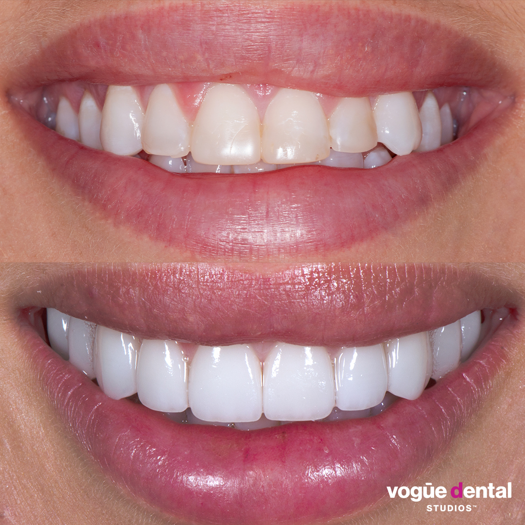 Before and after porcelain veneers at Vogue Dental Studios - Front View Bonnie Anderson Neighbours