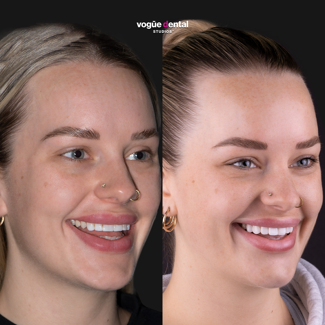 Picasso Porcelain Veneers Before And After Heidi Vogue Dental Studios