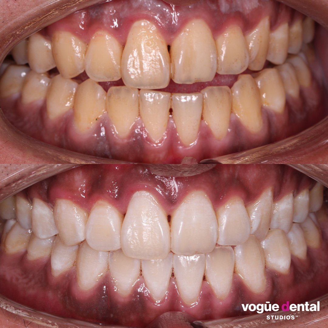 Before and after in-chair teeth whitening at Vogue Dental Studios - prior severe staining. Zhuo