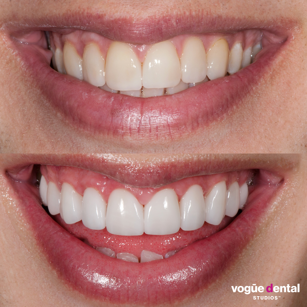 Liam Ferrari before and after porcelain veneers at Vogue Dental Studios.