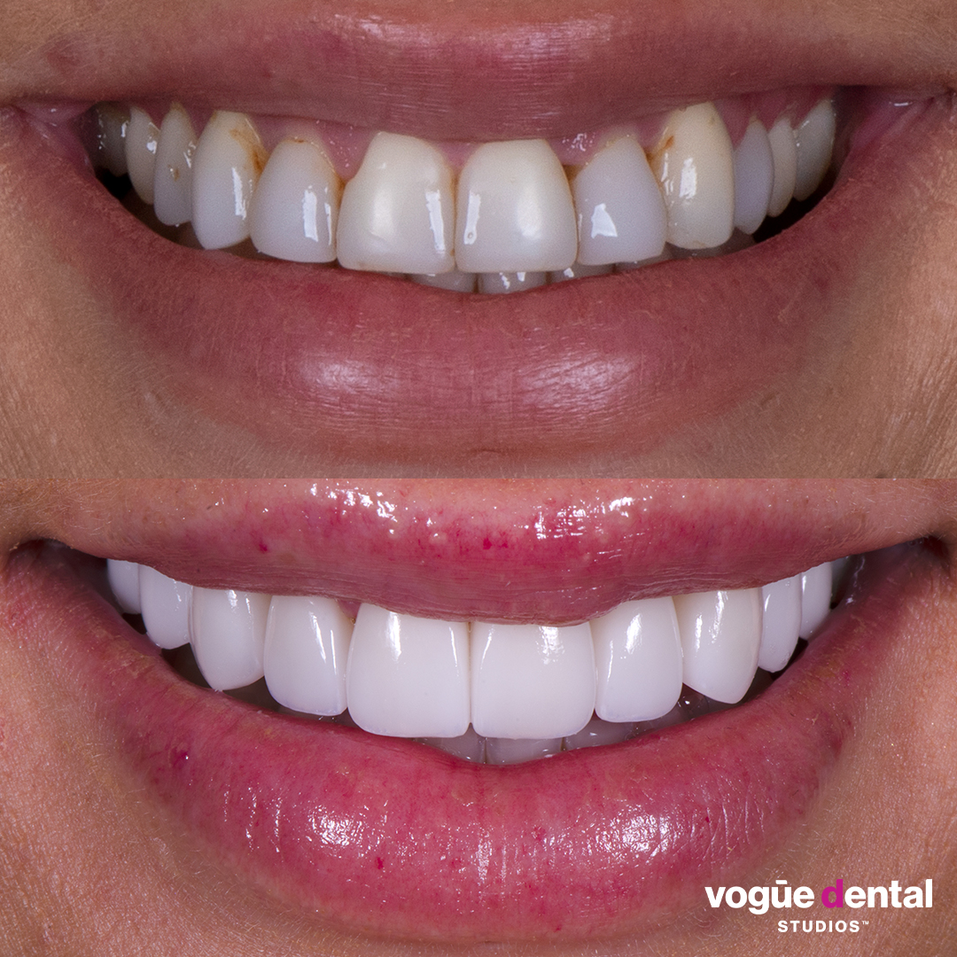 Before and after porcelain veneers at Vogue Dental Studios - Front View Jessica Brody The Bachelor