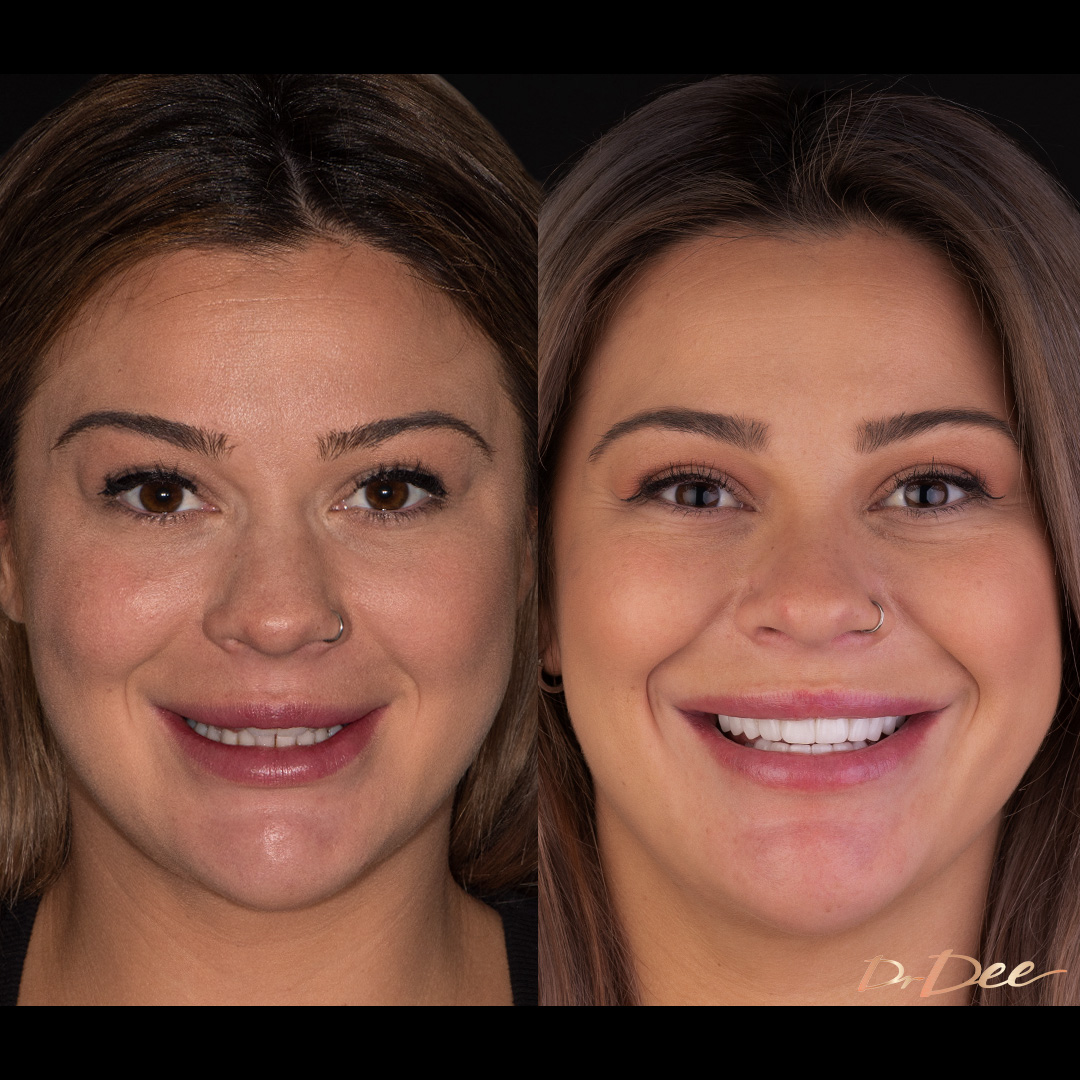 Melbourne Chippy Chick Stefanie porcelain veneers for narrow smile by Dr Dee - full face view