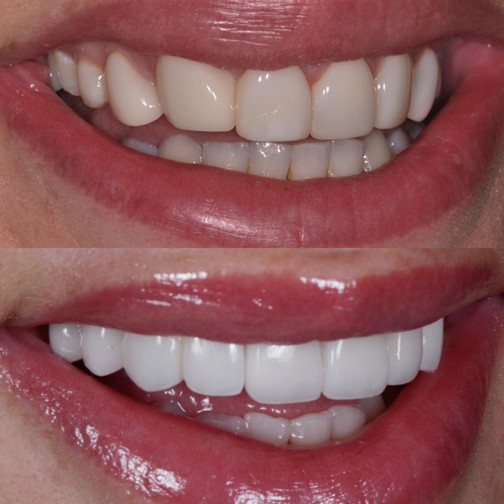 Before and after replacement veneers on Jessika Power at Vogue Dental Stuidos.