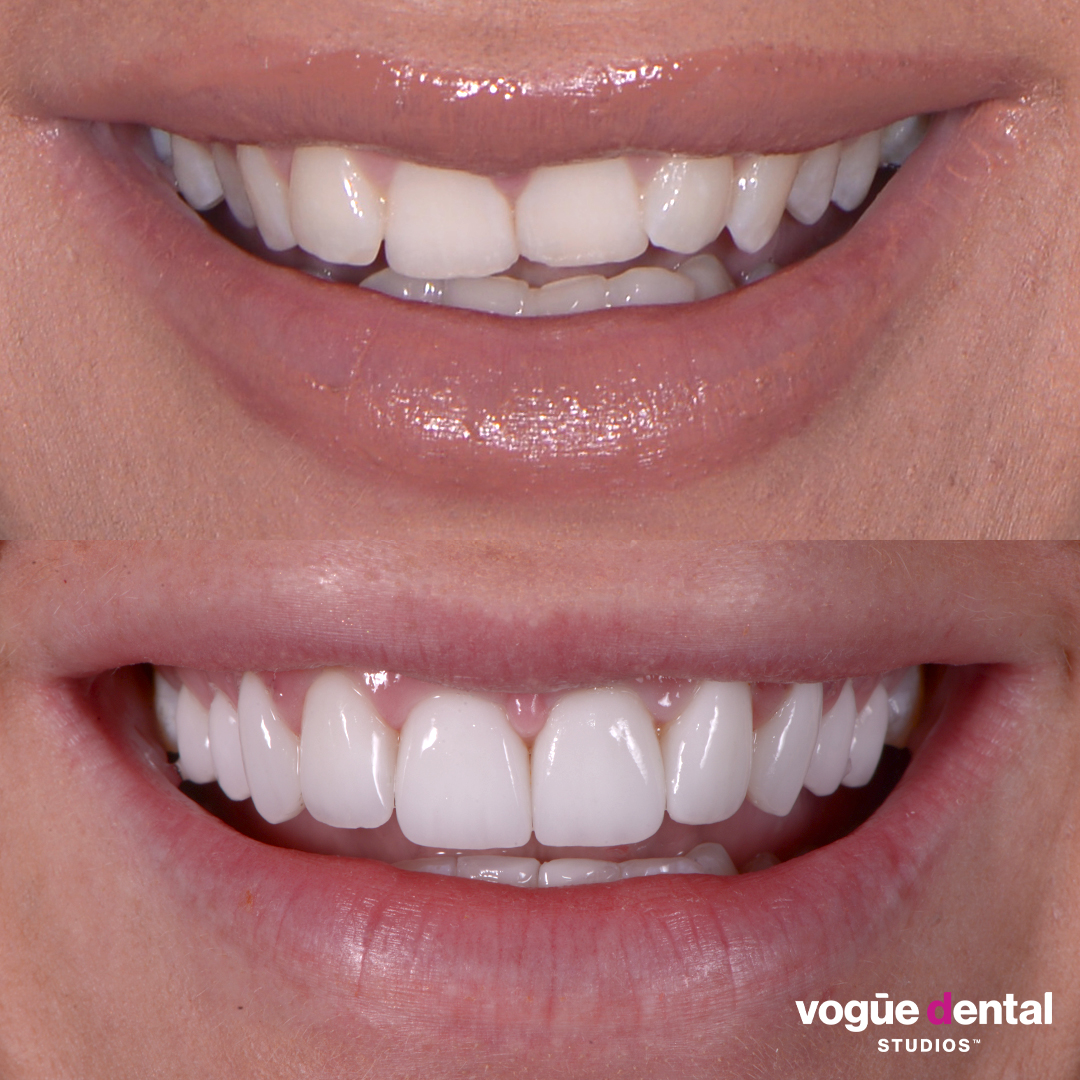Simone Anderson dental veneers smile transformation with Dr Dee.