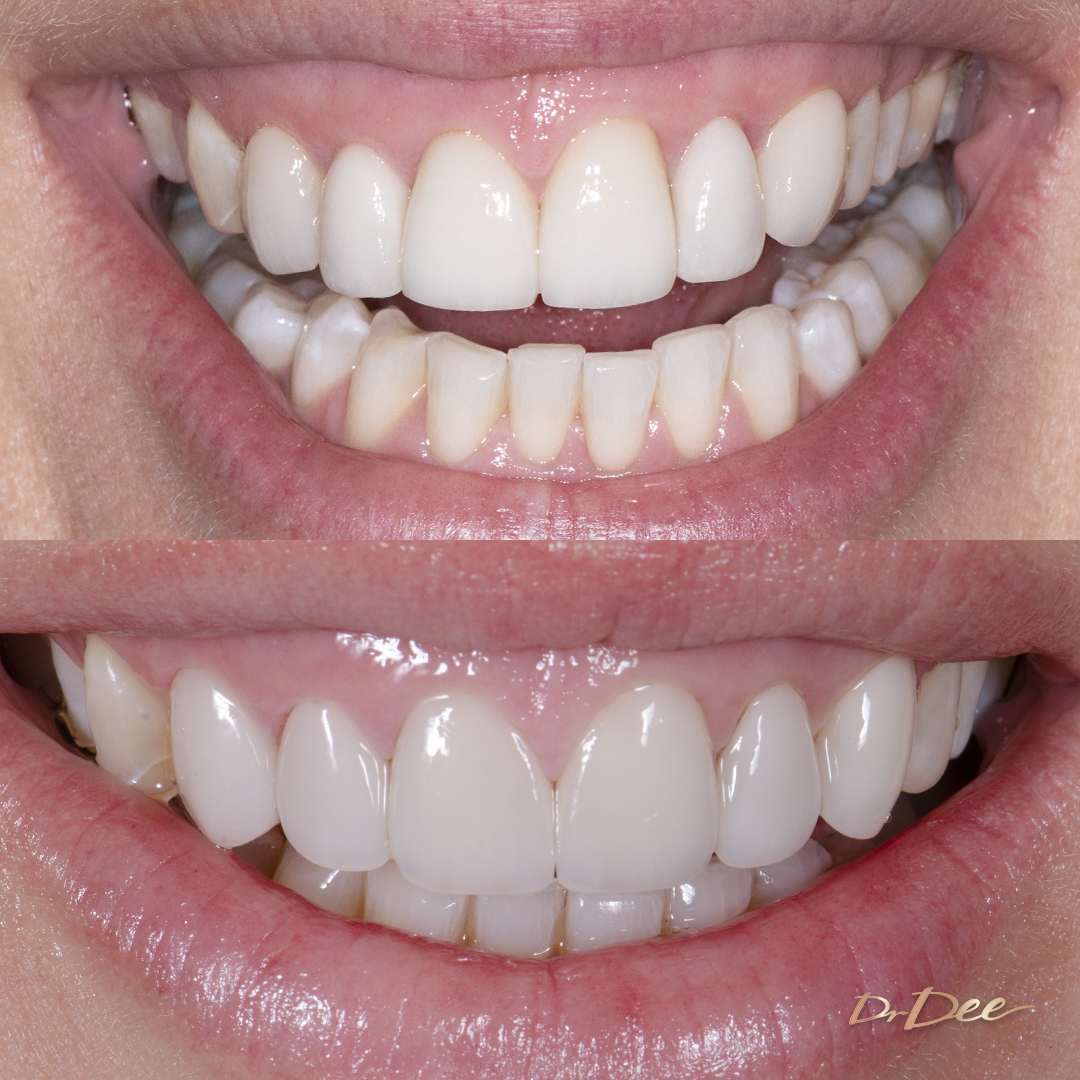Before and after with porcelain veneers at Vogue Dental Studios - front teeth view Cara