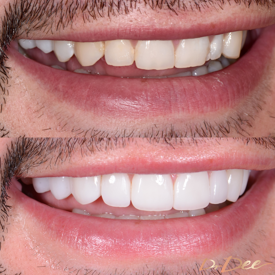 Brandon Smith before and after Picasso Porcelain Veneers for small teeth.