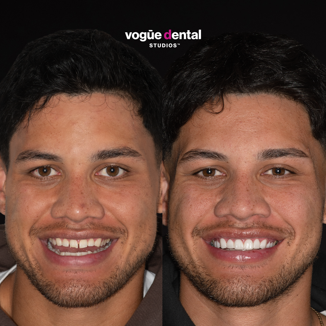 Before and after smile makeover Jaxson