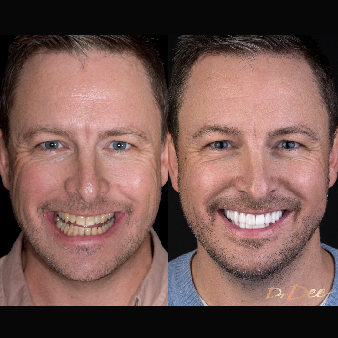 Before and after veneers for staining Matt Ridley - front face view