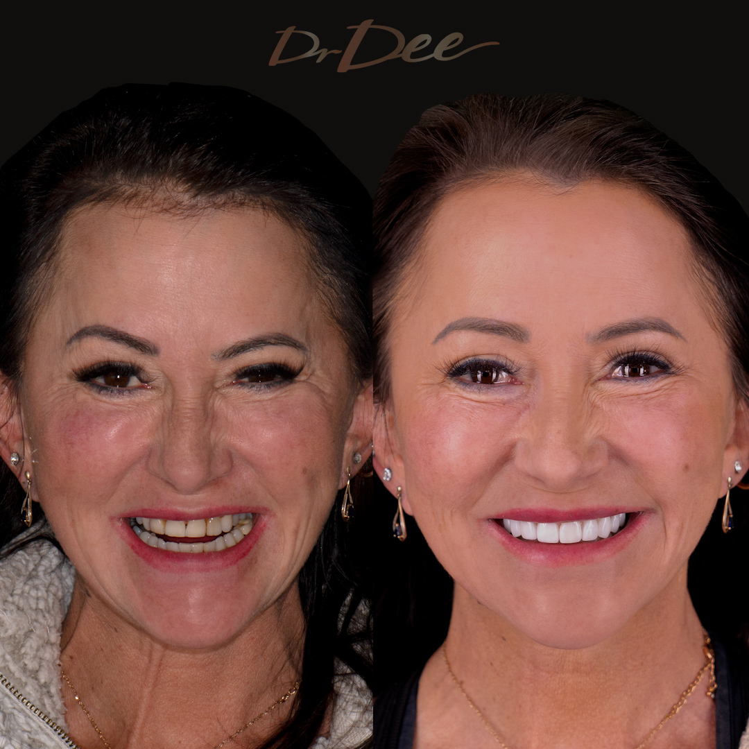 Before and after porcelain veneers at Vogue Dental Studios - Full face view Kate