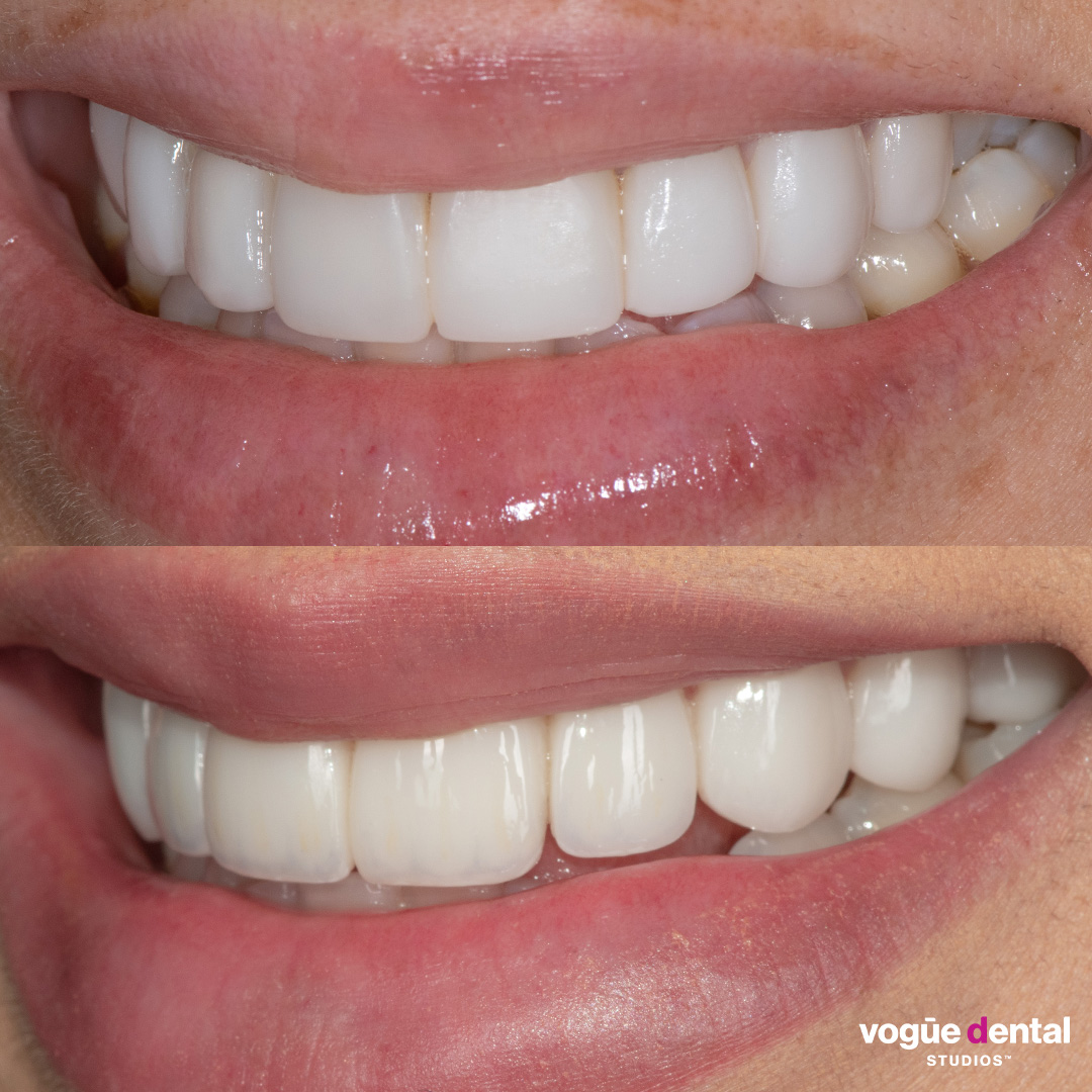Carolina Santos revision veneers custom smile design Vogue Dental Studios - left smile