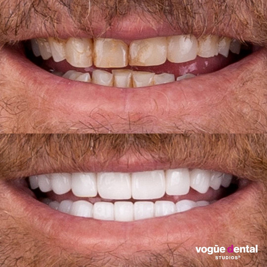 Before and after small teeth with porcelain veneers at Vogue Dental Studios - front teeth Karl