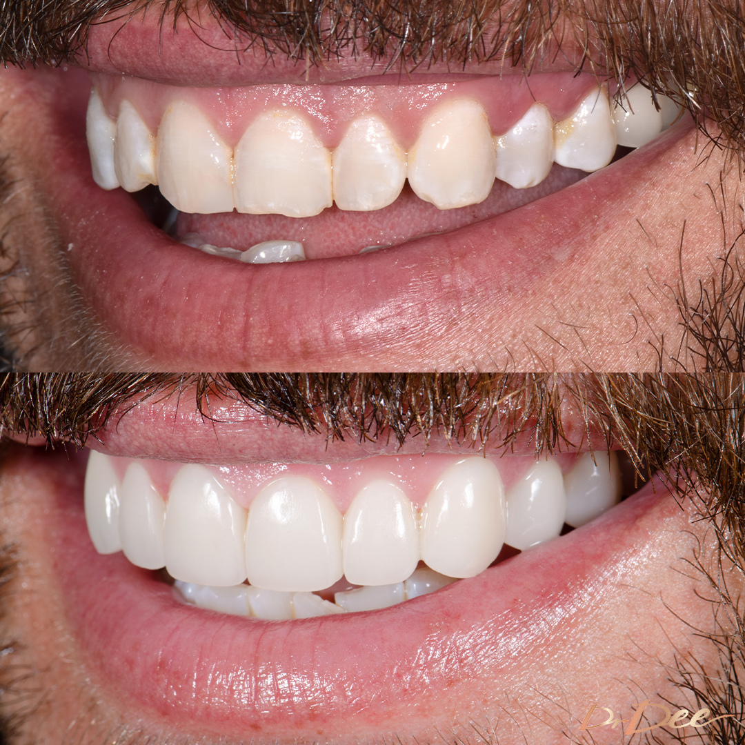 Sandor Early uneven smile line addressed with Picasso Procelain Veneers by Dr Dee, left view.