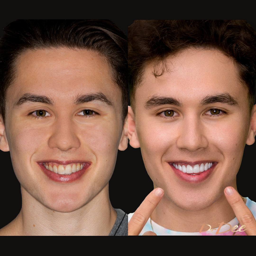 Liam Ferrari before and after Picasso Porcelain Veneers face view.