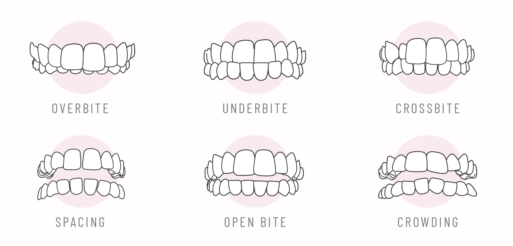 Illustration of various forms of malocclusion: overbite, underbite, crossbite, teeth spacing or gap teeth, open bite, crowding or crooked teeth.