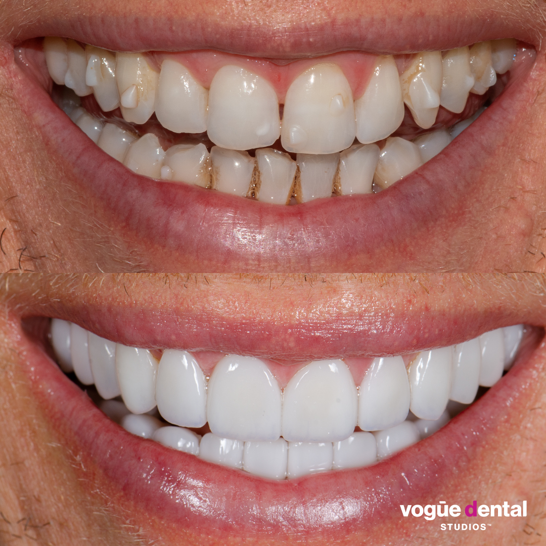 Before and after smile makeover Luke Hines - front smile view