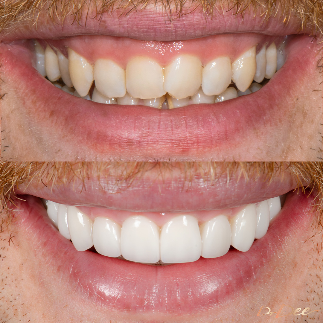 Before and after veneers for gummy smile Jackson Lonie - front smile view