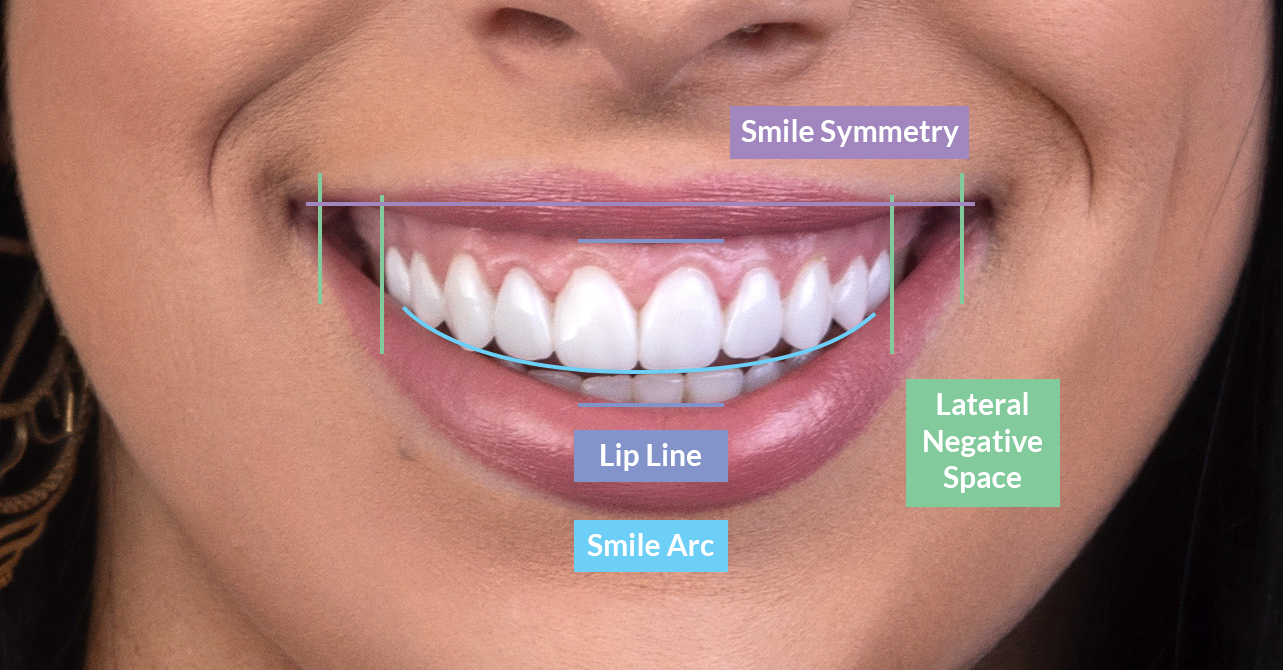 Lip lines and symmetry in smile design on our patient at Vogue Dental Studios.