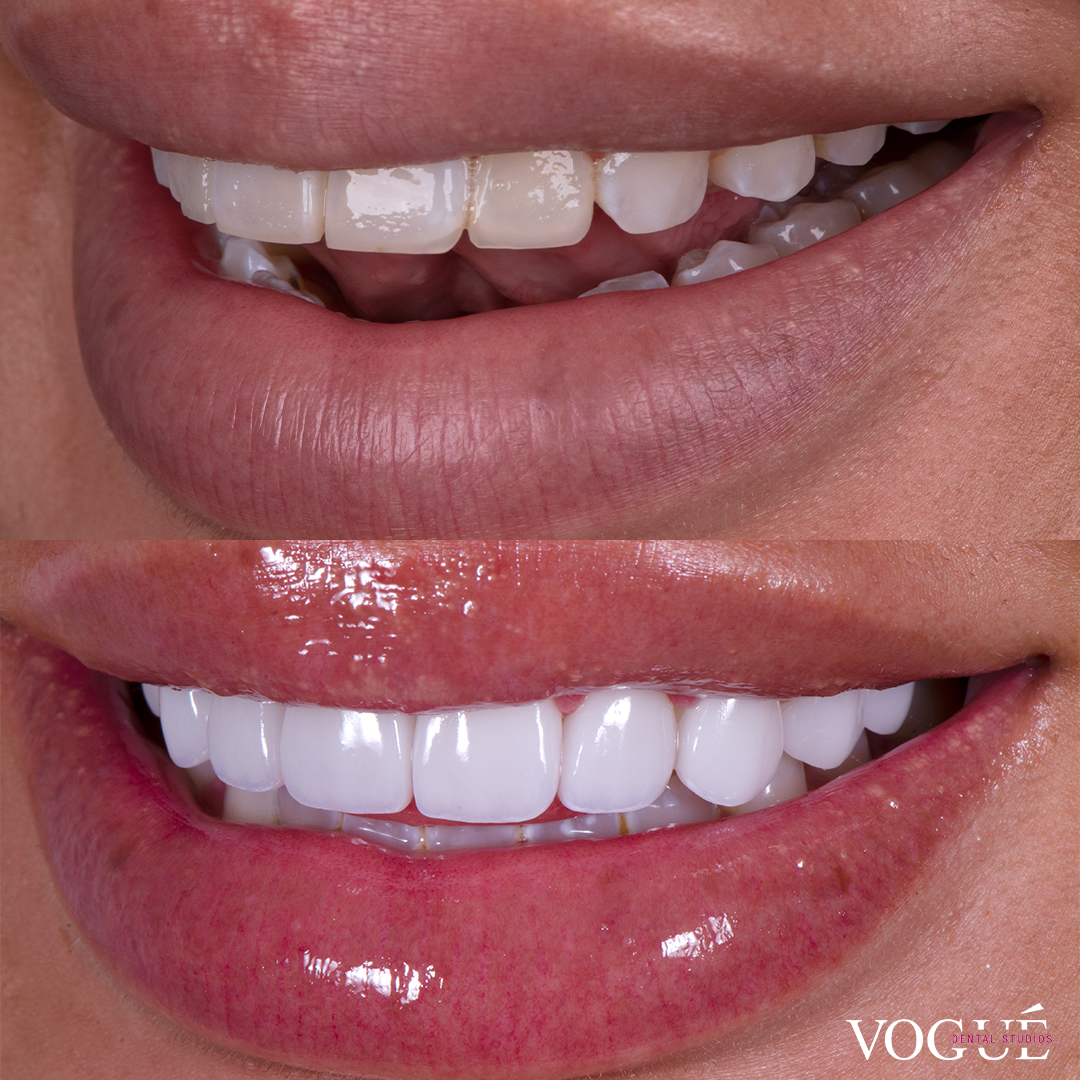 Miss Zedd revision veneers at Vogue Dental Studios before and after left view.