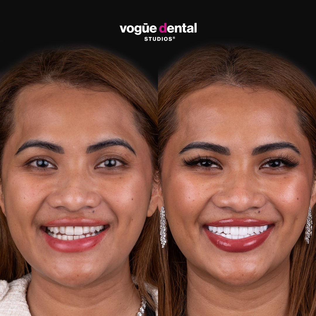 Before and after uneven gums with porcelain veneers at Vogue Dental Studios - front teeth view Nita.
