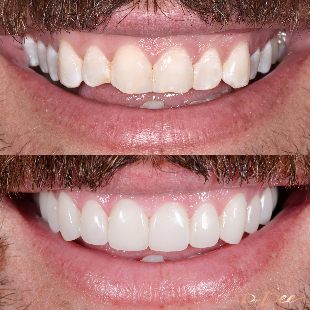Sandor Earl uneven smile line addressed with Picasso Procelain Veneers by Dr Dee, front view.