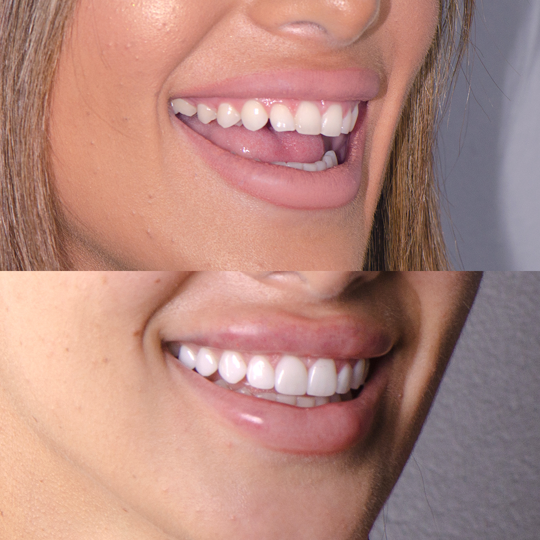 Christina Sikalias before and after porcelain veneers to fix teeth shape at Vogue Dental Studios.